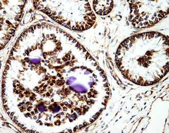 Photomicrograph of a testicular tumor from a bilateral cryptorchid goat (400x).  An immunohistochemical stain for vimentin was applied to identify mesenchymal cells.  Vimentin positive cells (indicated by brown staining) line tubules and form intralu