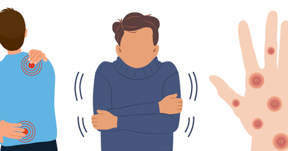 Illustration of aches, chills, and rash from mpox.