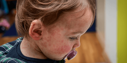 A child with measles. 